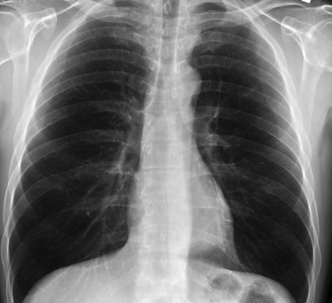 Location of the Heart on an X-Ray