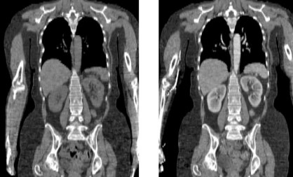 Iodine-Based Enhancements for CT Scans