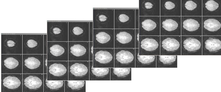 Stage 2 Anatomical Image Acquisition