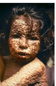 Photo of a Child with Smallpox