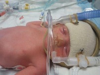 a premature baby on CPAP in the NICU.^[Photo by Jennifer Paris used with permission]