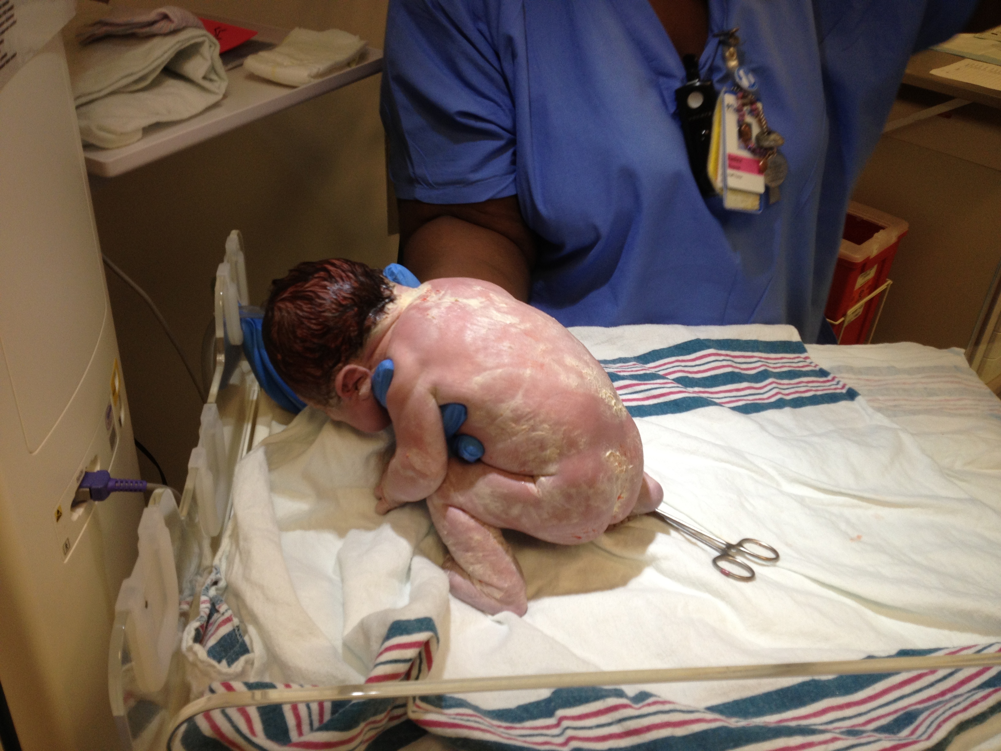 A newborn baby covered in vernix.^[[Image](https://www.flickr.com/photos/upsand/7377877798/in/photostream/) by [Upsilon Andromedae](https://www.flickr.com/photos/upsand/) is licensed under [CC BY 2.0](https://creativecommons.org/licenses/by/2.0/)]
