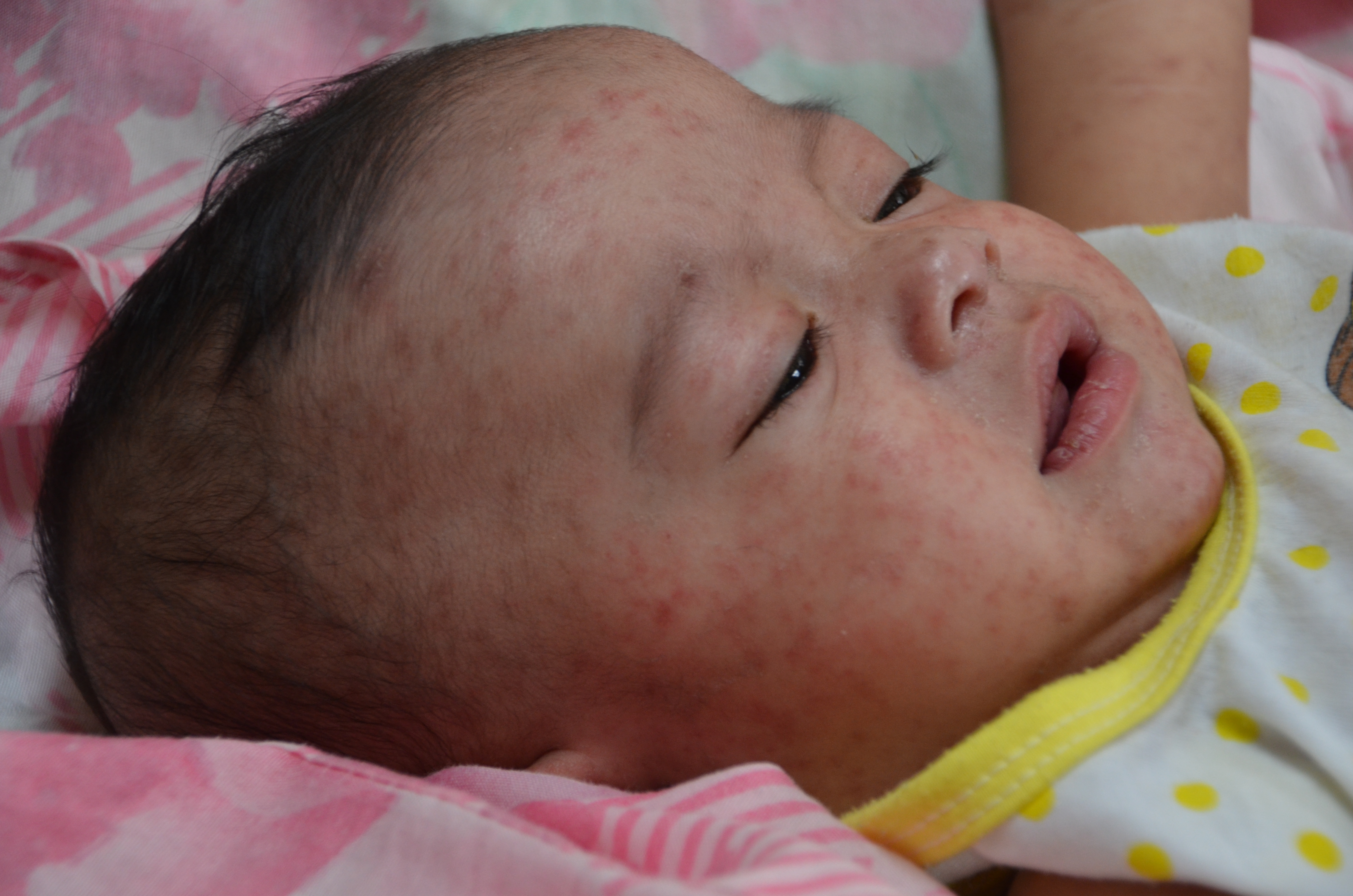 A baby with measles^[[Image](https://www.flickr.com/photos/cdcglobal/13627881194) by [CDC Global](https://www.flickr.com/photos/cdcglobal/) is licensed under [CC BY 2.0](https://creativecommons.org/licenses/by/2.0/)]