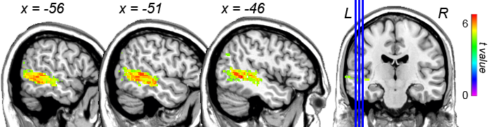 VLSM results for picture naming accuracy after controlling for visual and motor speech impairments. The colours indicate the strength of the associations. Only the left hemisphere is shown. L = Left; R = Right. VLSM results for making this figure are a courtesy of Juliana Baldo.