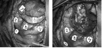 Intraoperative photograph of the exposed cortical surface before (left) and after (right) the removal of the tumour. The numbers indicate the locations that were tested with direct cortical stimulation.