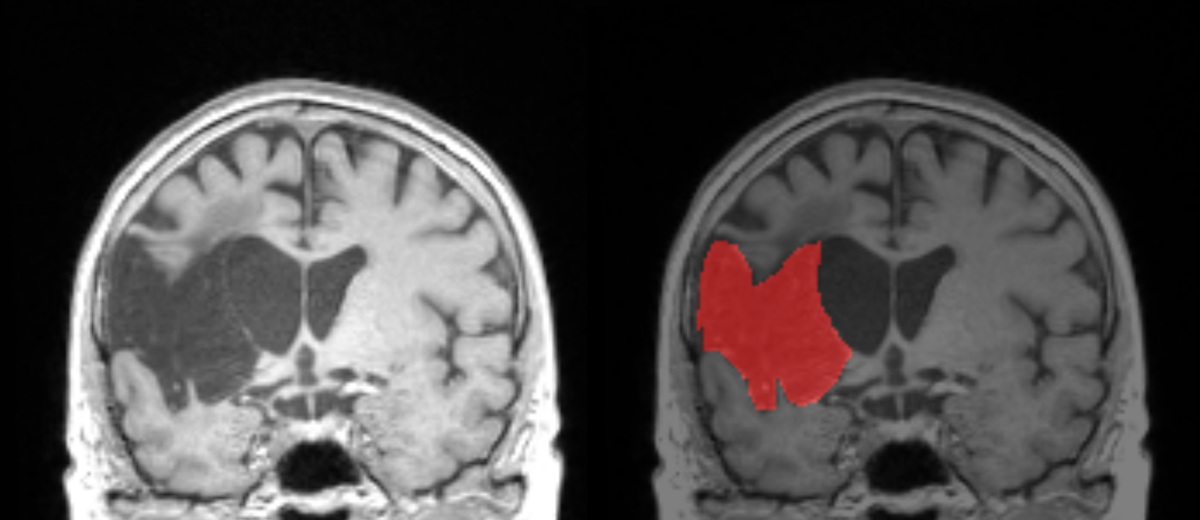 Illustration of a structural image with a stroke lesion (left) and the corresponding lesion mask in red (right). The lesion mask is expressed as a 3D volume of values. In this example, the voxels in red have the value of 1, that is, lesioned, whereas the non-coloured voxels have the value of 0, that is, not lesioned.